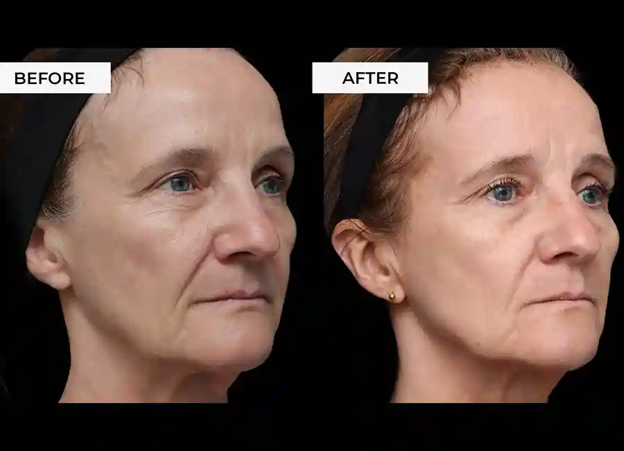 How Many RF Microneedling Sessions Will You Need to See a Difference Beaconsfield?