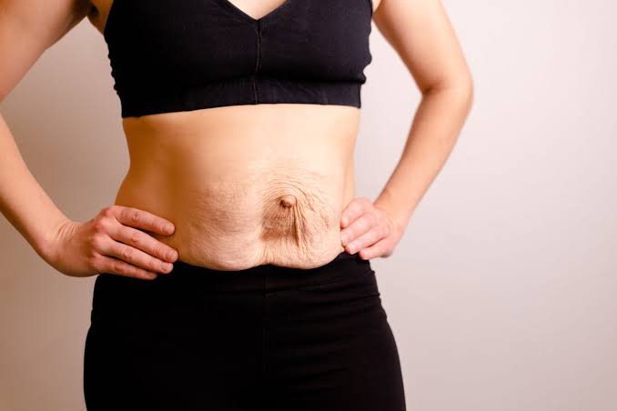Is Surgery Really the Only Way to Repair Diastasis Recti Beaconsfield?