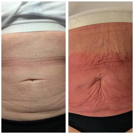 How Does RF Microneedling Improve Crepey, Thin and Uneven Skin Texture Beaconsfield?