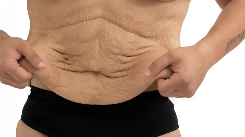 Why Does Weight Loss Medication Leave Some People With Loose or Sagging Skin Beaconsfield?